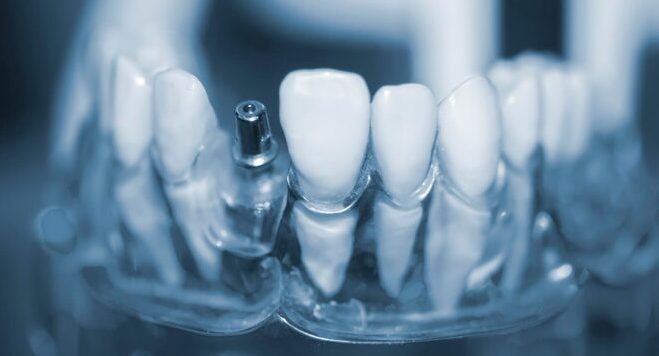 Implantes dentales